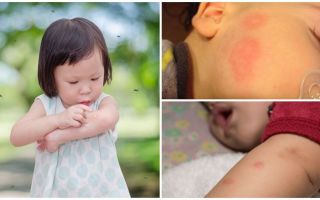 Las picaduras de mosquitos en la piel de un adulto o niño