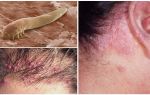 Síntomas y tratamiento del ácaro del cabello en humanos.