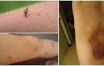 ¿Por qué quedan las contusiones después de las picaduras de mosquitos?