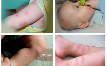 Qué hacer si un niño es mordido por una pulga, picaduras de fotos