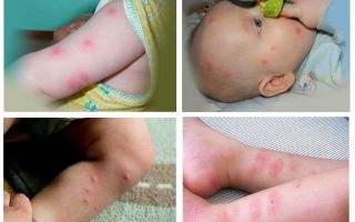 Qué hacer si un niño es mordido por una pulga, picaduras de fotos