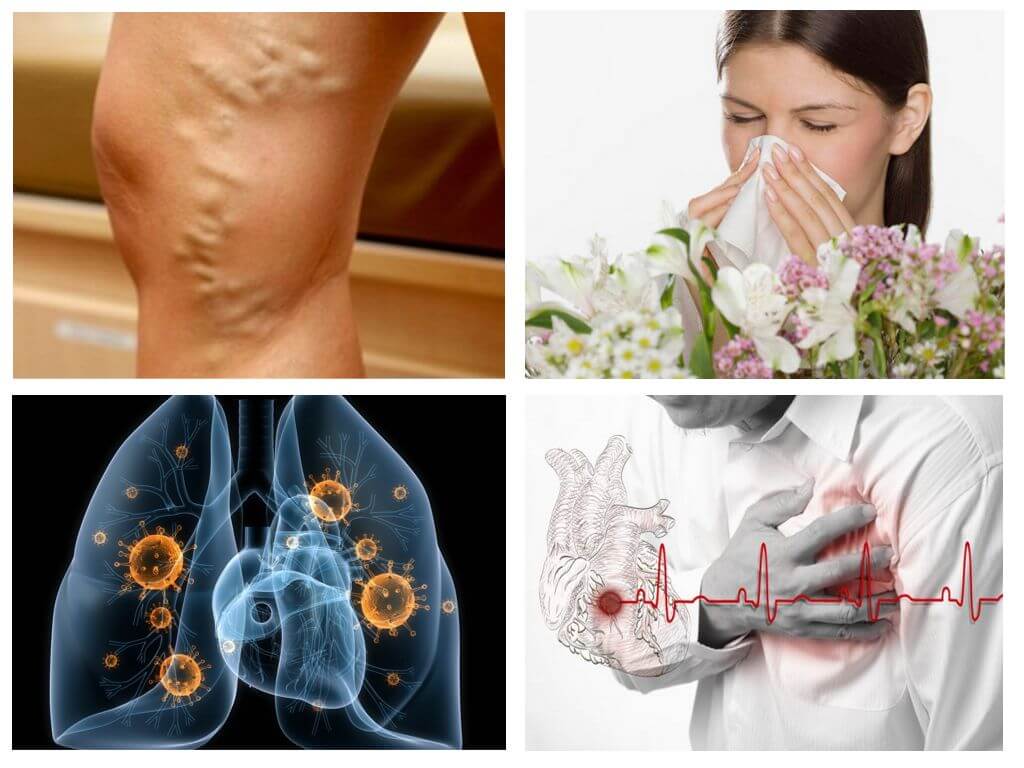 Alergia, cardiopatía, tuberculosis.