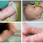 Las picaduras de pulgas en un niño