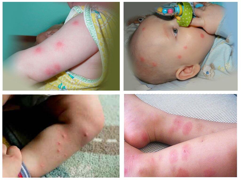 Las picaduras de pulgas en un niño