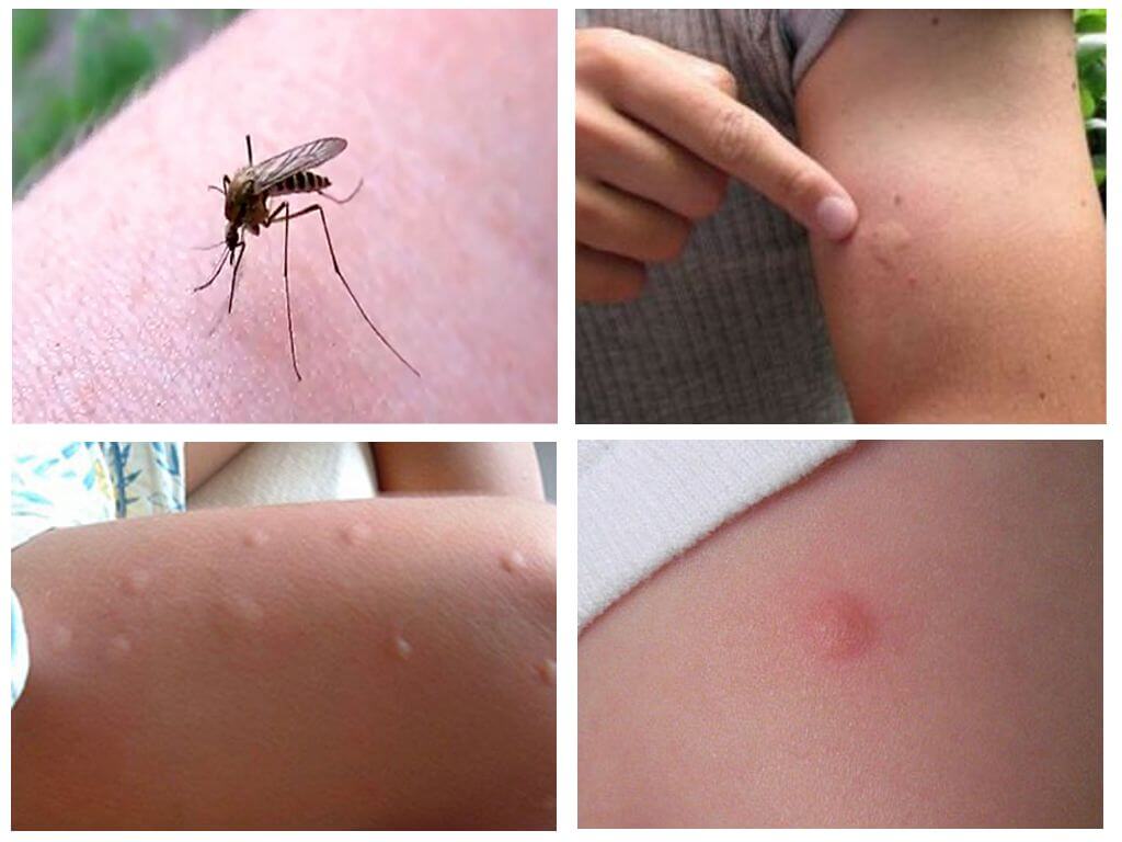 Picaduras de mosquitos