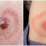 Enfermedad de Lyme o borreliosis transmitida por garrapatas
